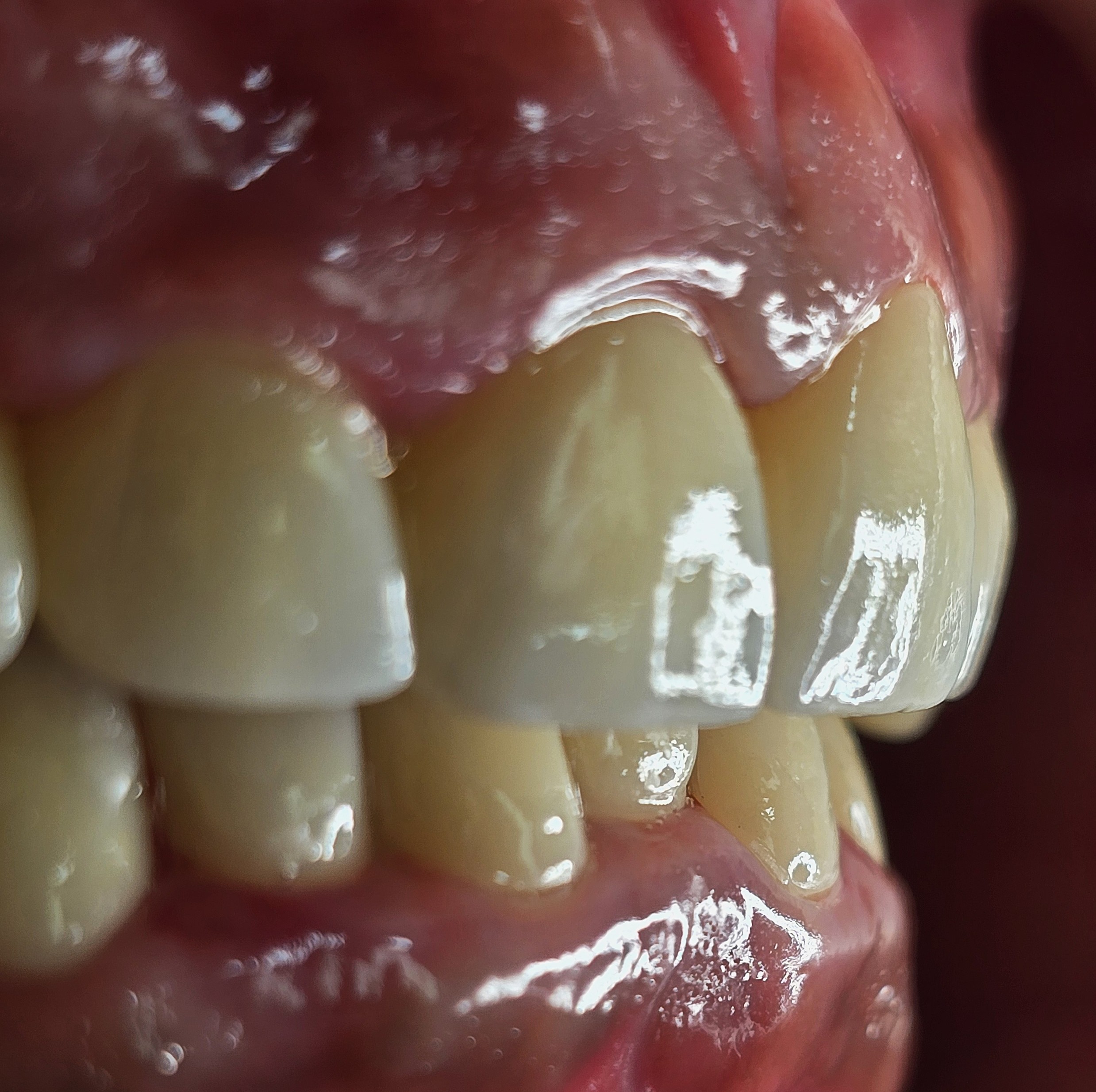 Smile Design After 1
