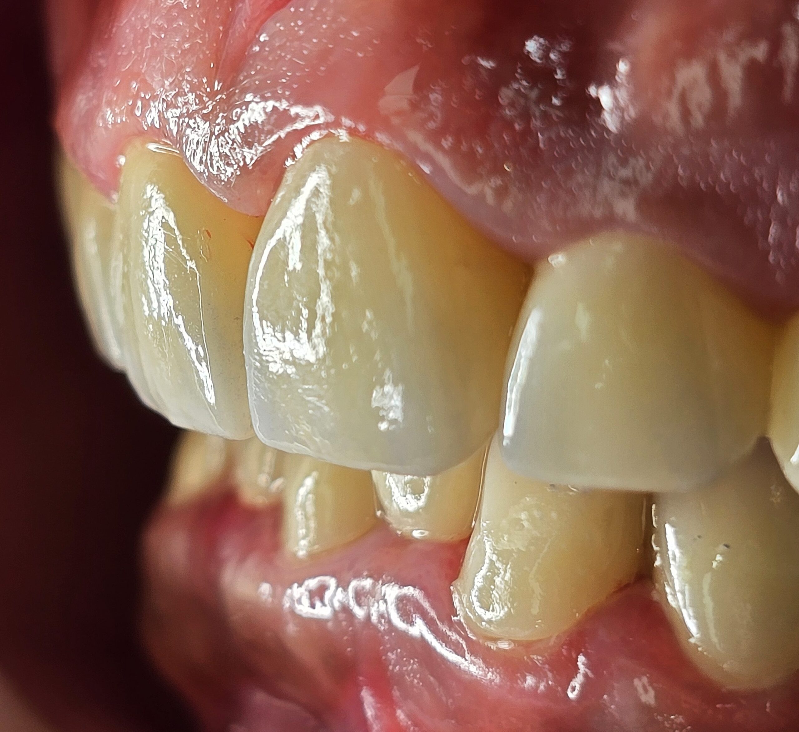 Smile Design Result