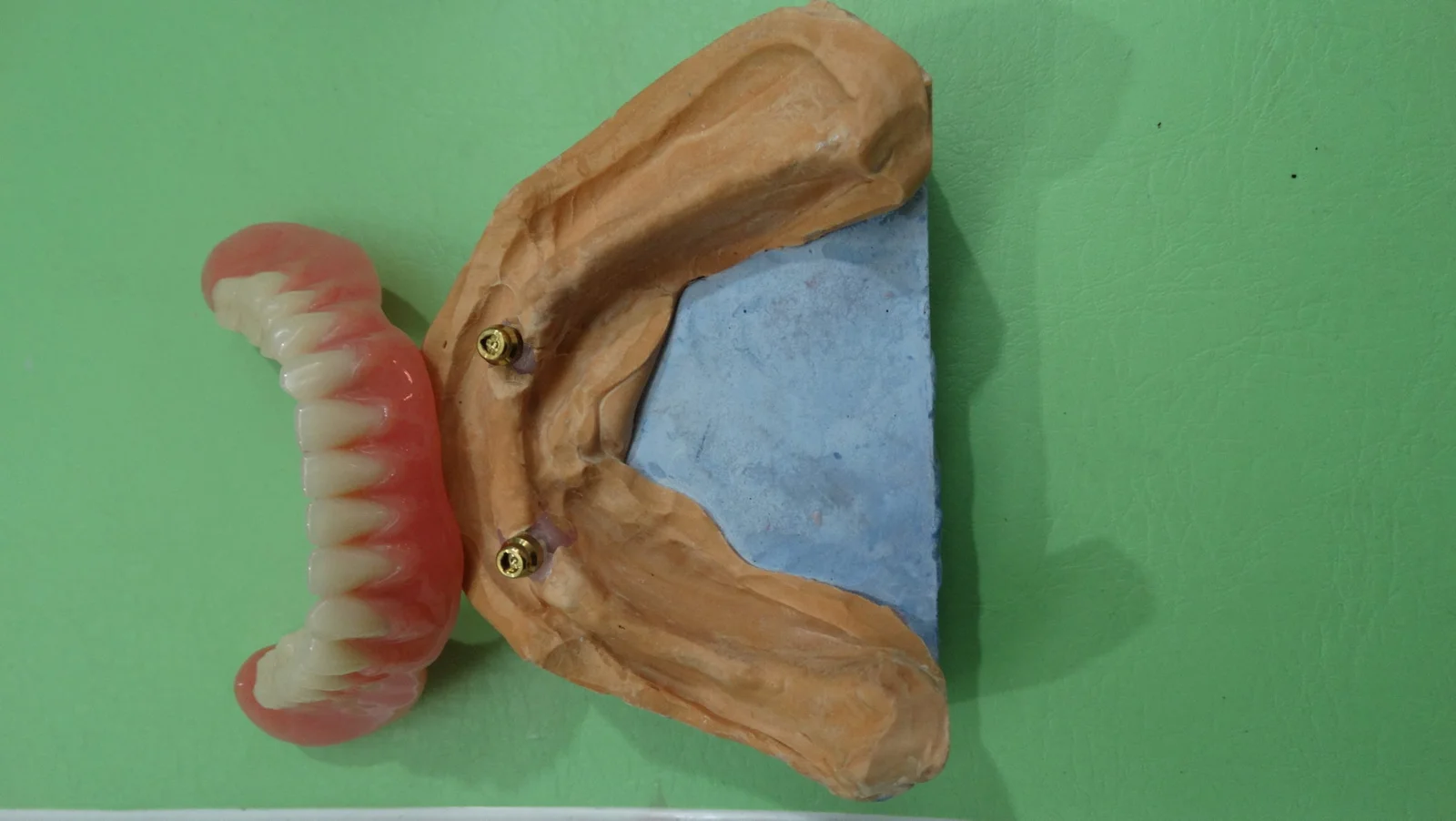 Removal Denture Stage 4