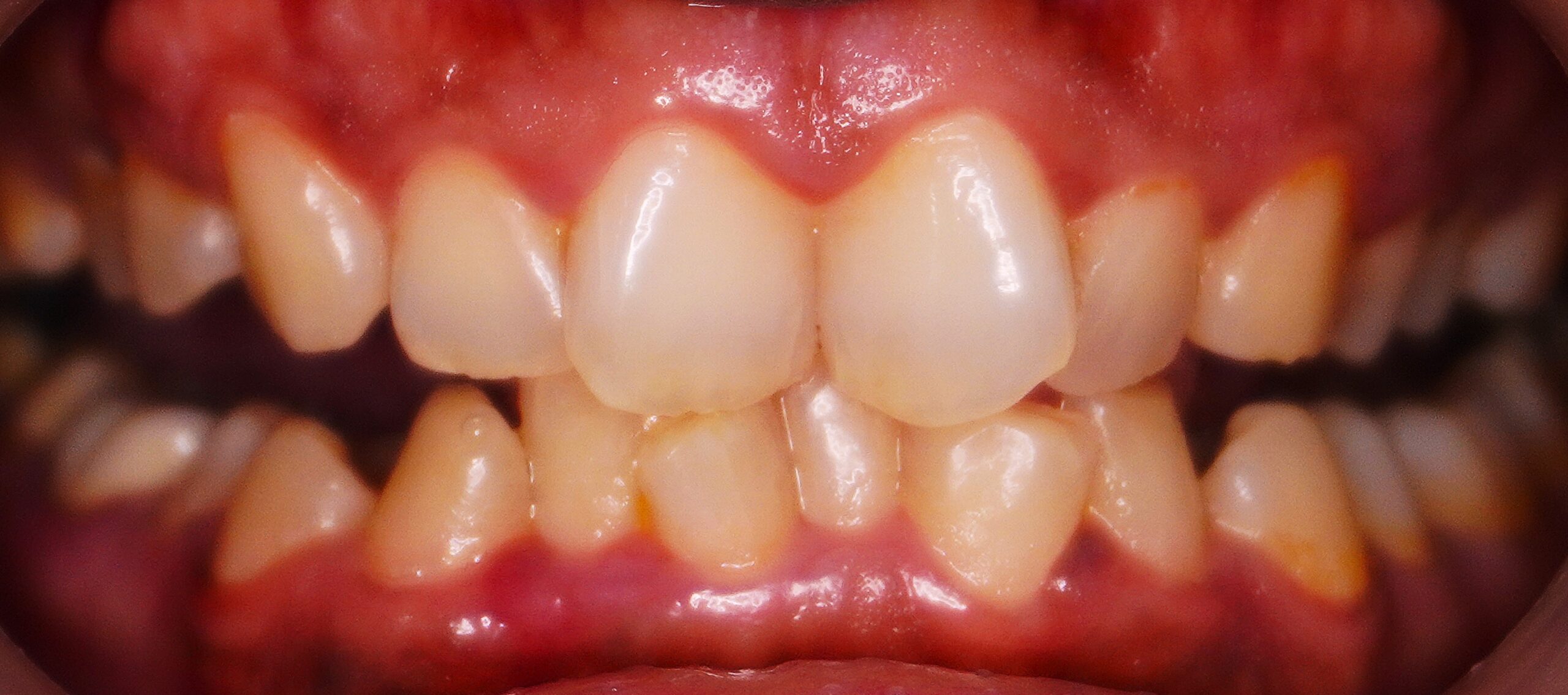 Smile Design Before