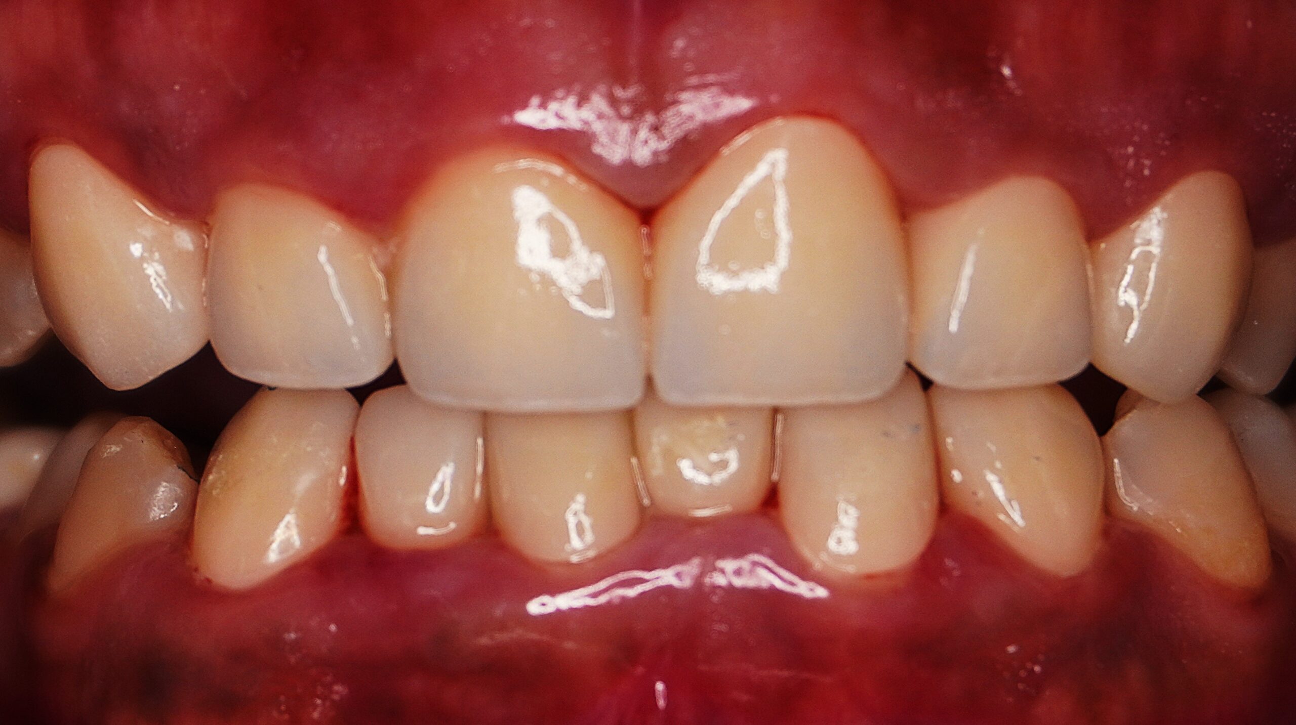 Smile Design Details