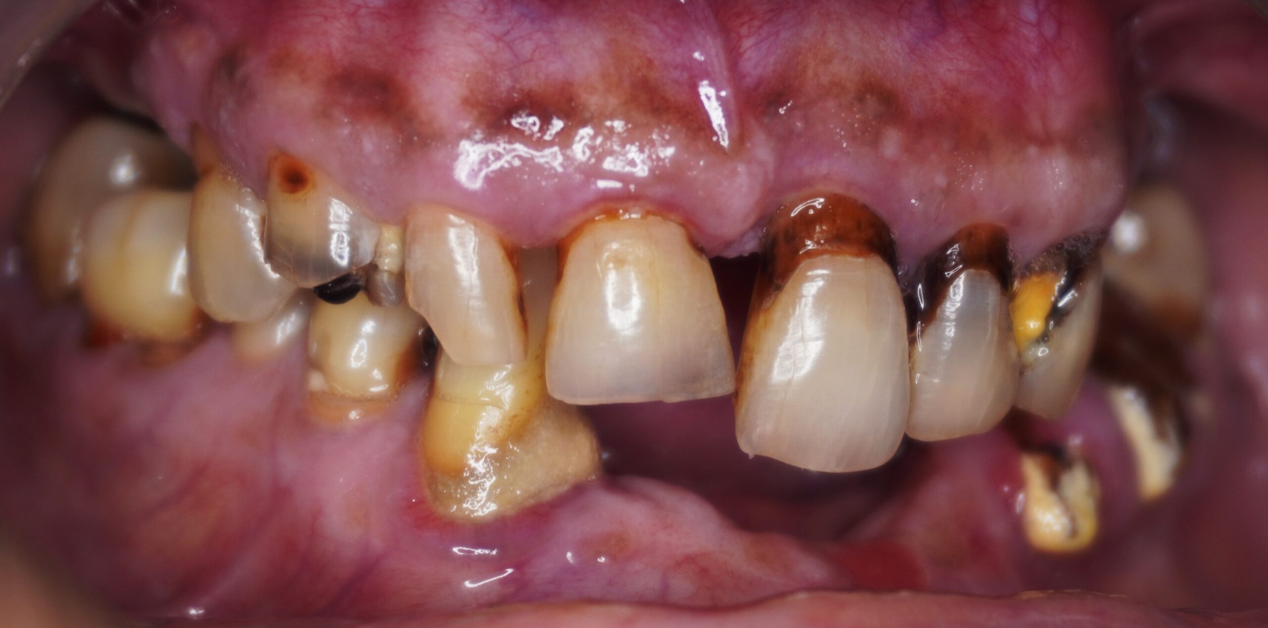 Fixed Teeth Before
