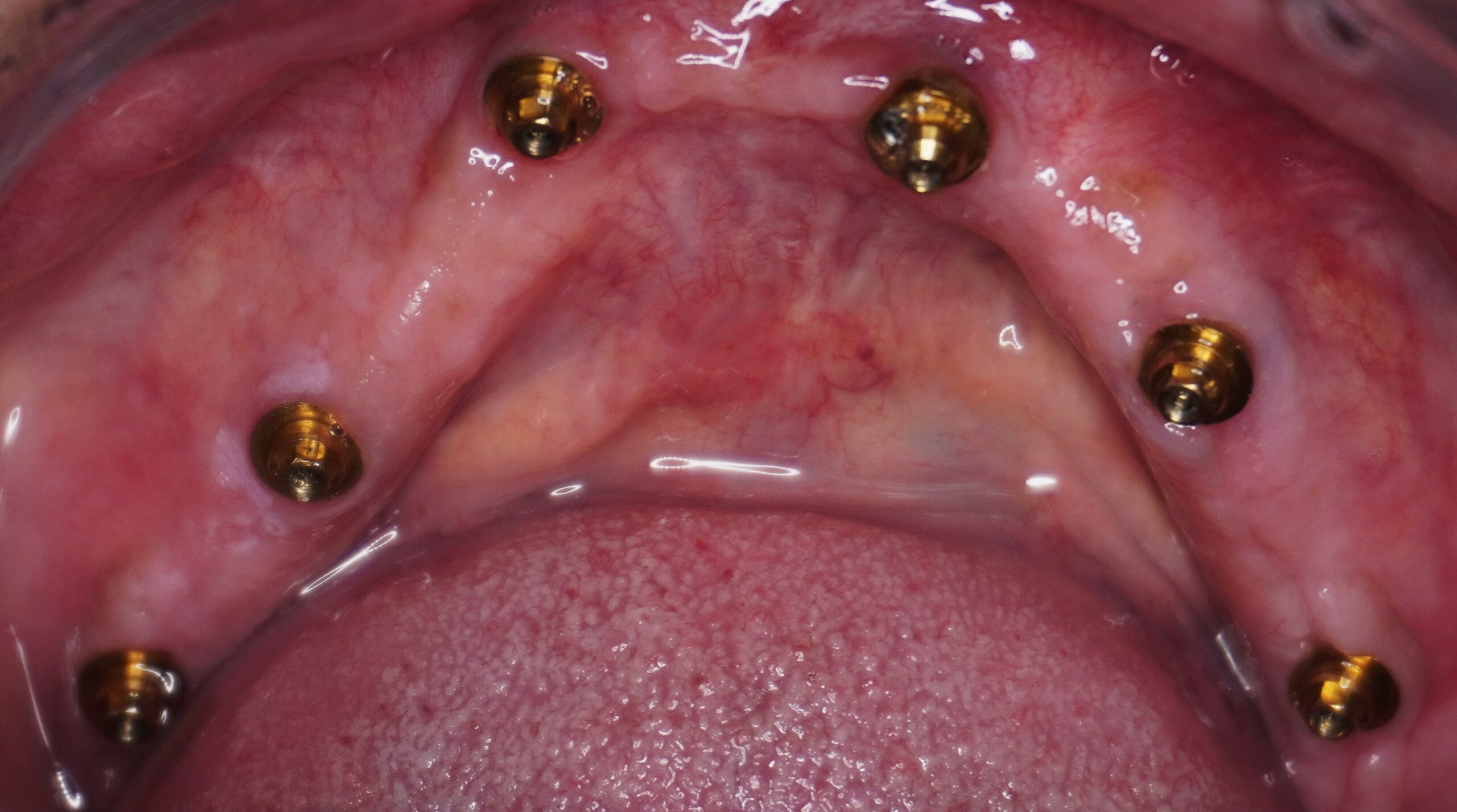 Fixed Teeth Case Study 4