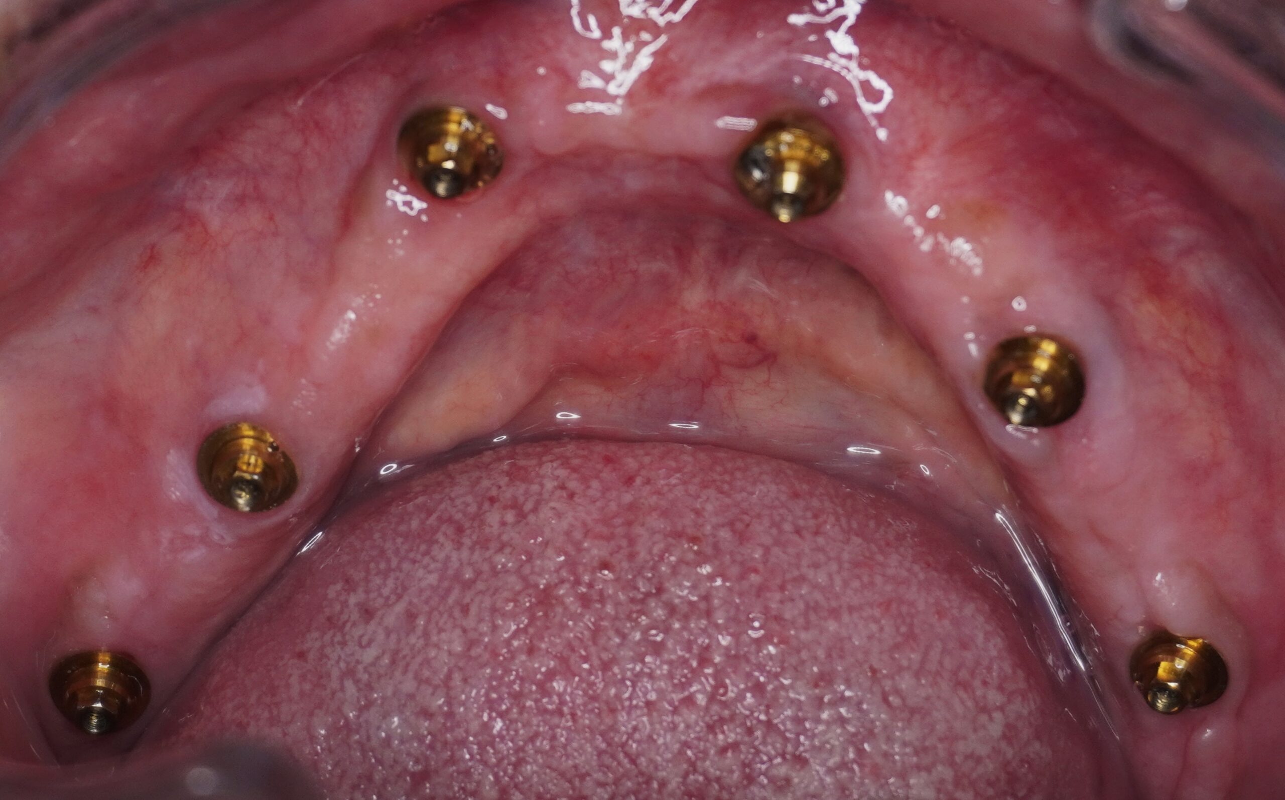 Fixed Teeth Case Study 3