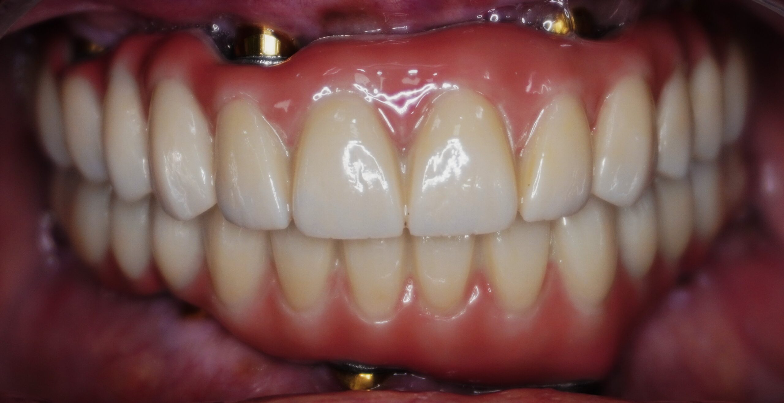 Fixed Teeth After