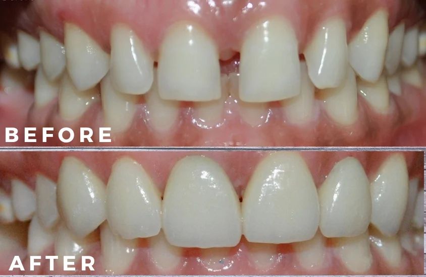 Composite Laminates Transformation