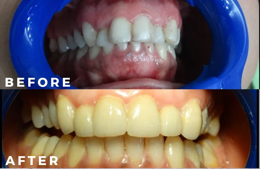 Clear Aligner Smile