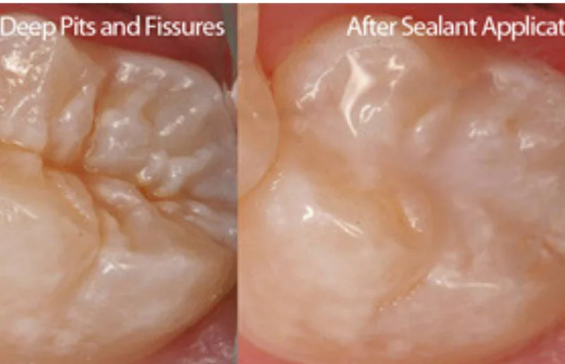 Pits Fissure Sealant