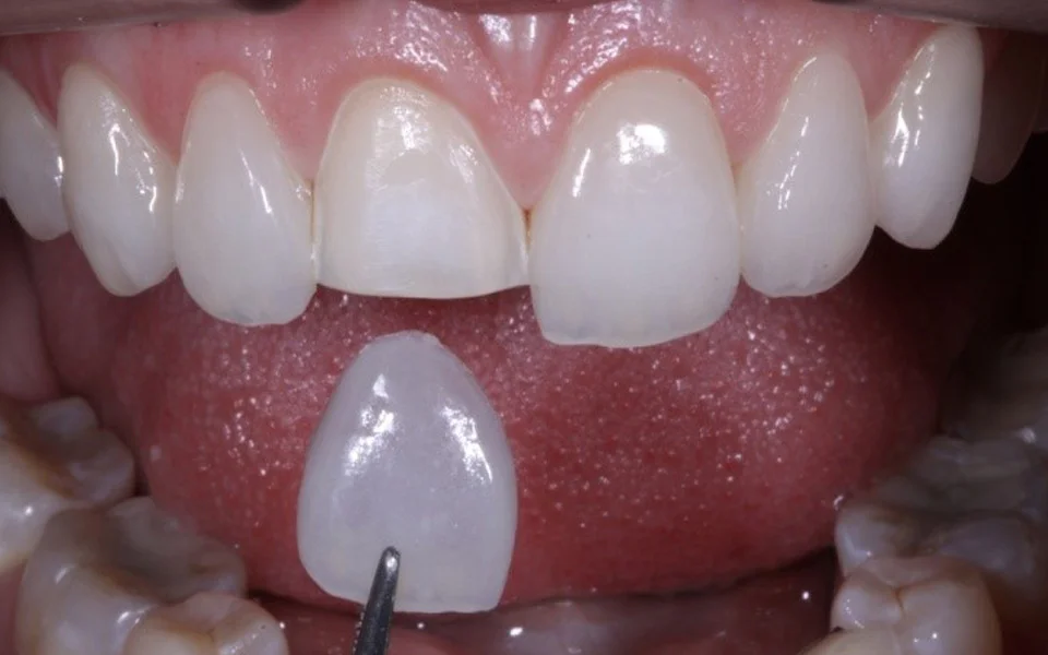 Ceramic Laminates Preparation