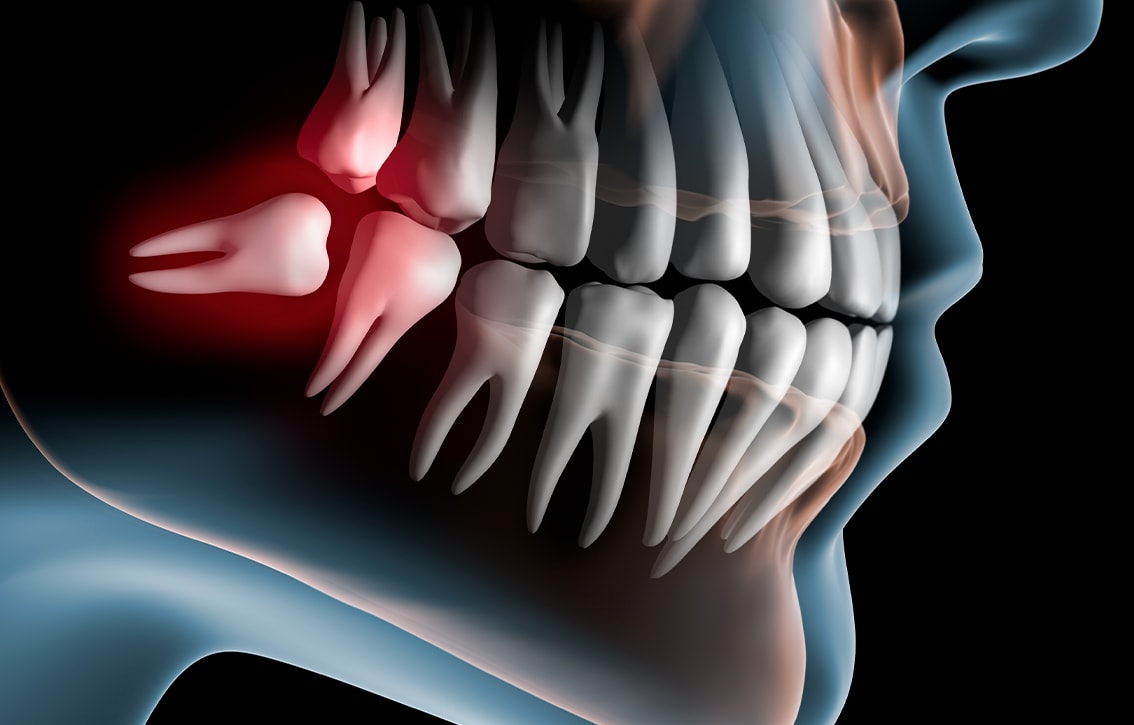Wisdom Tooth Extraction